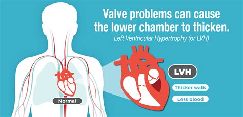 lvh medical term.